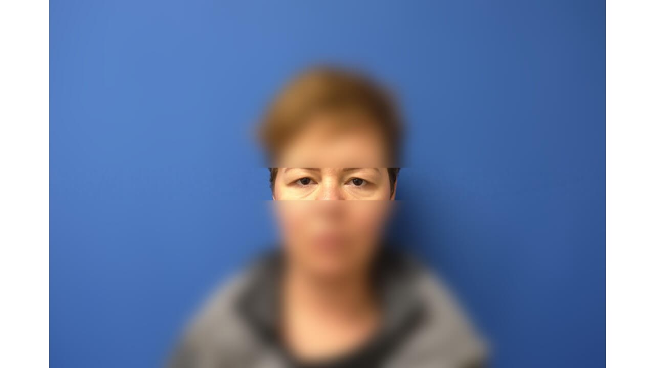 Upper Eyelid Surgery Before