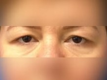 Upper Eyelid Surgery Before