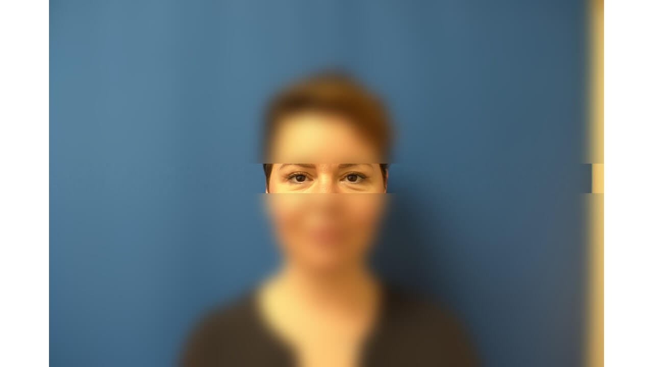 Upper Eyelid Surgery After