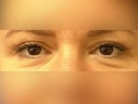 Upper Eyelid Surgery After