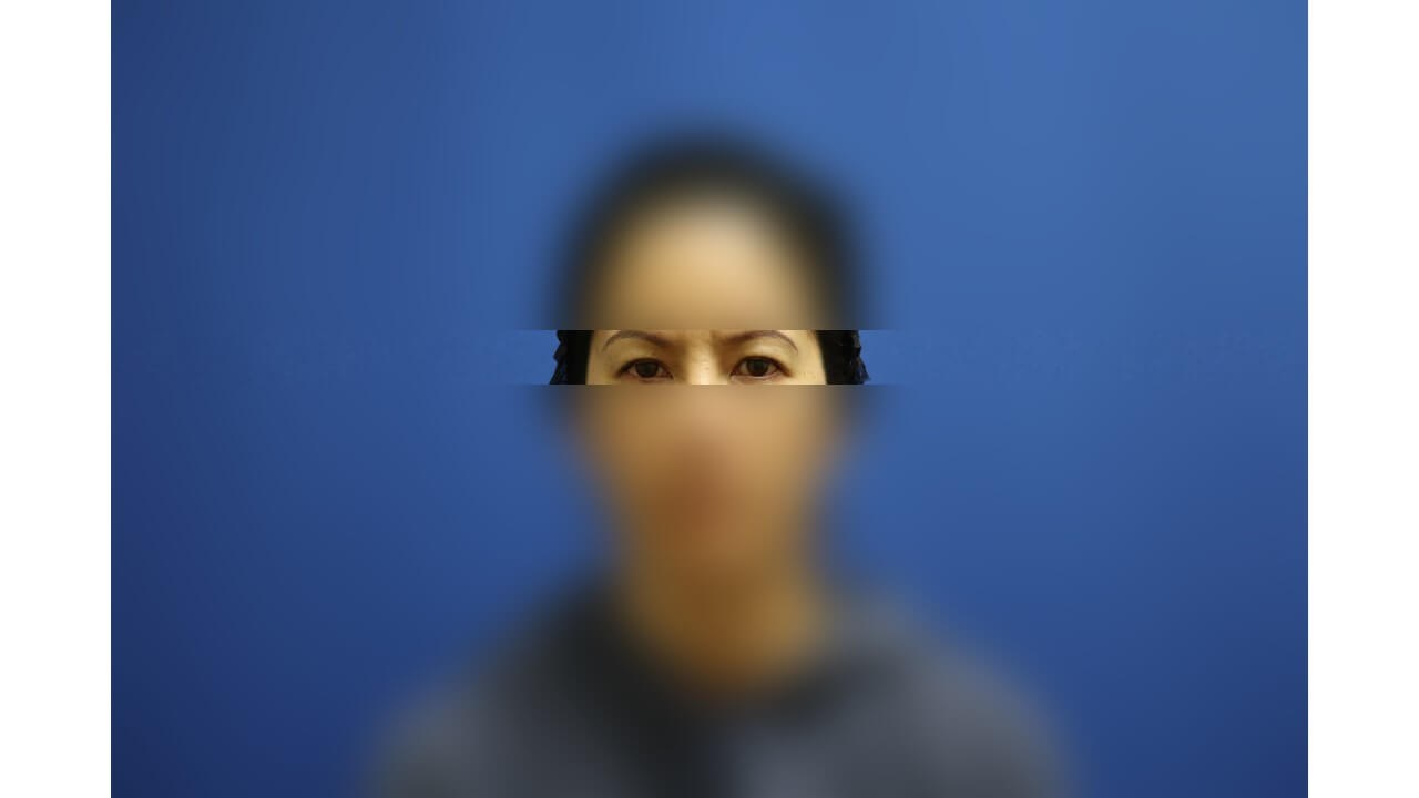 Upper Eyelid Surgery Before