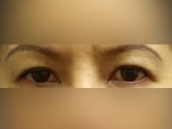Upper Eyelid Surgery Before