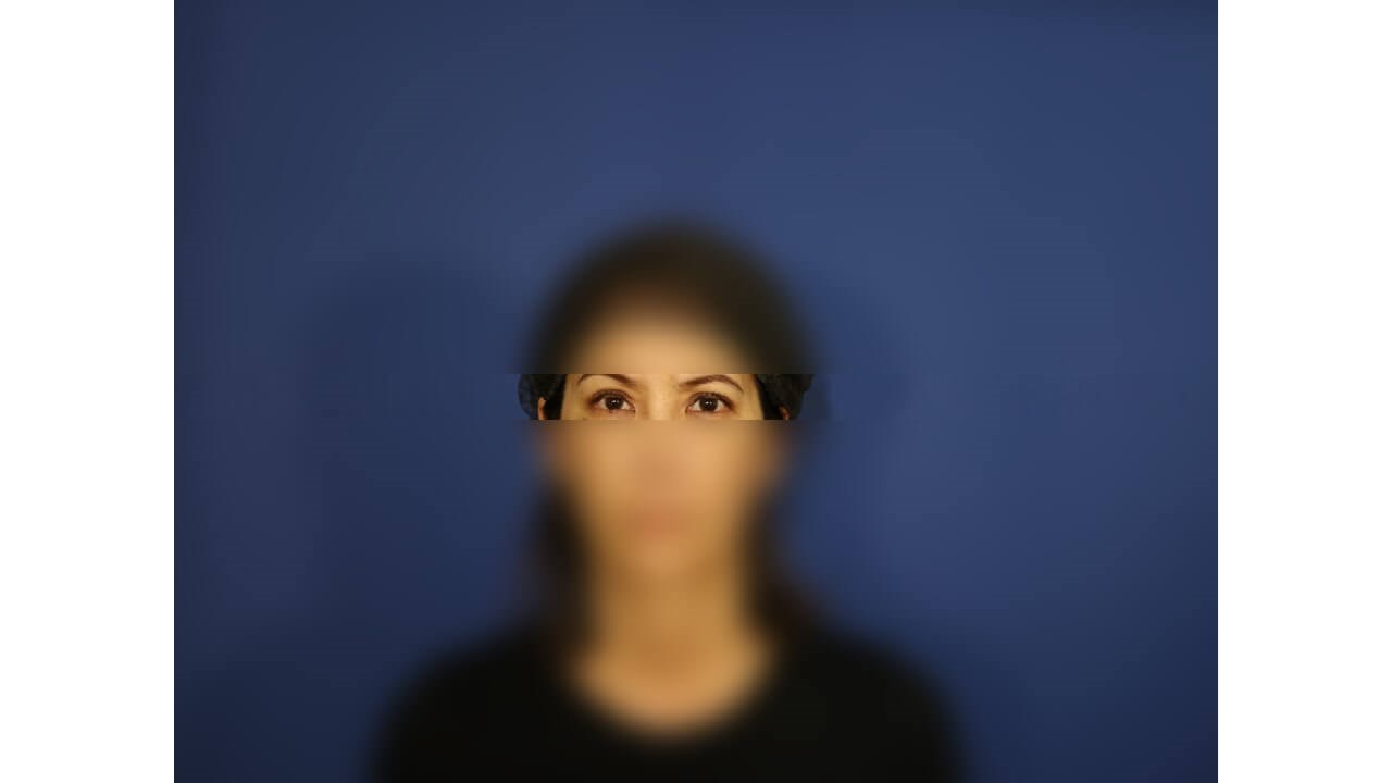 Upper Eyelid Surgery After