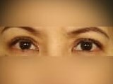 Upper Eyelid Surgery After