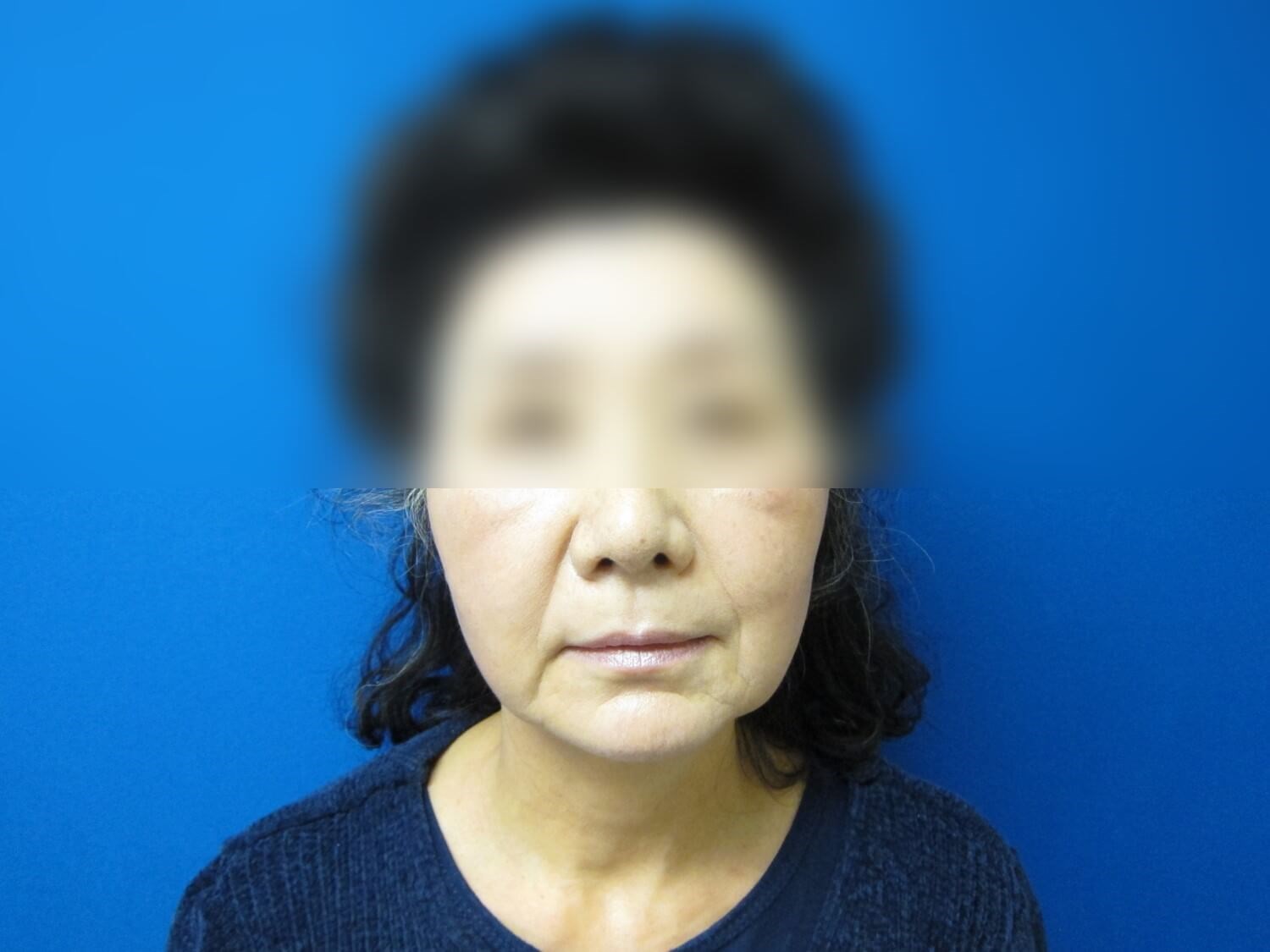Facelift Before