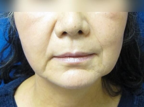 Facelift Before