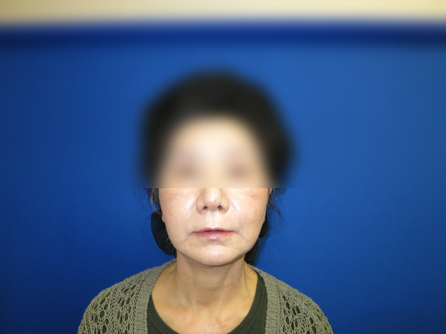 Facelift After