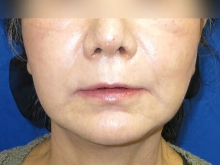 Facelift After