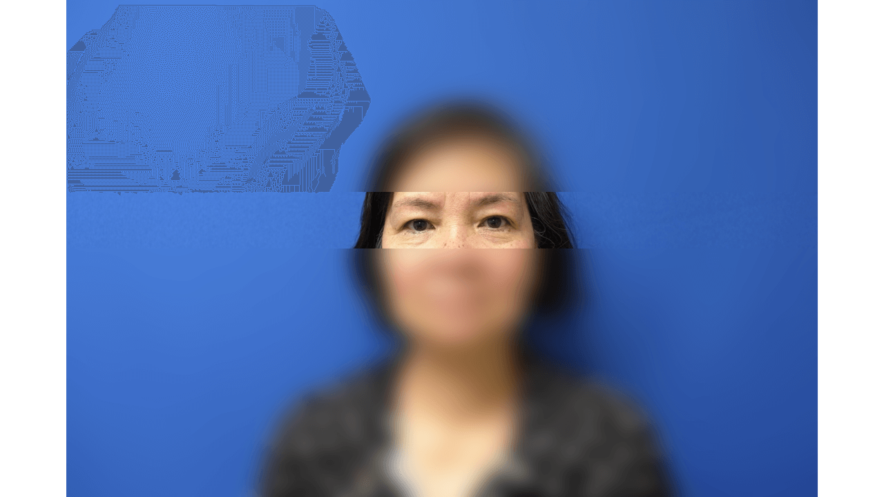 Upper Eyelid Surgery Before
