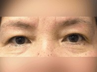 Upper Eyelid Surgery Before
