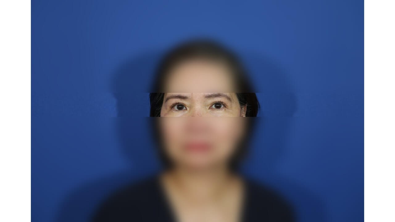 Upper Eyelid Surgery After
