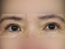 Upper Eyelid Surgery After