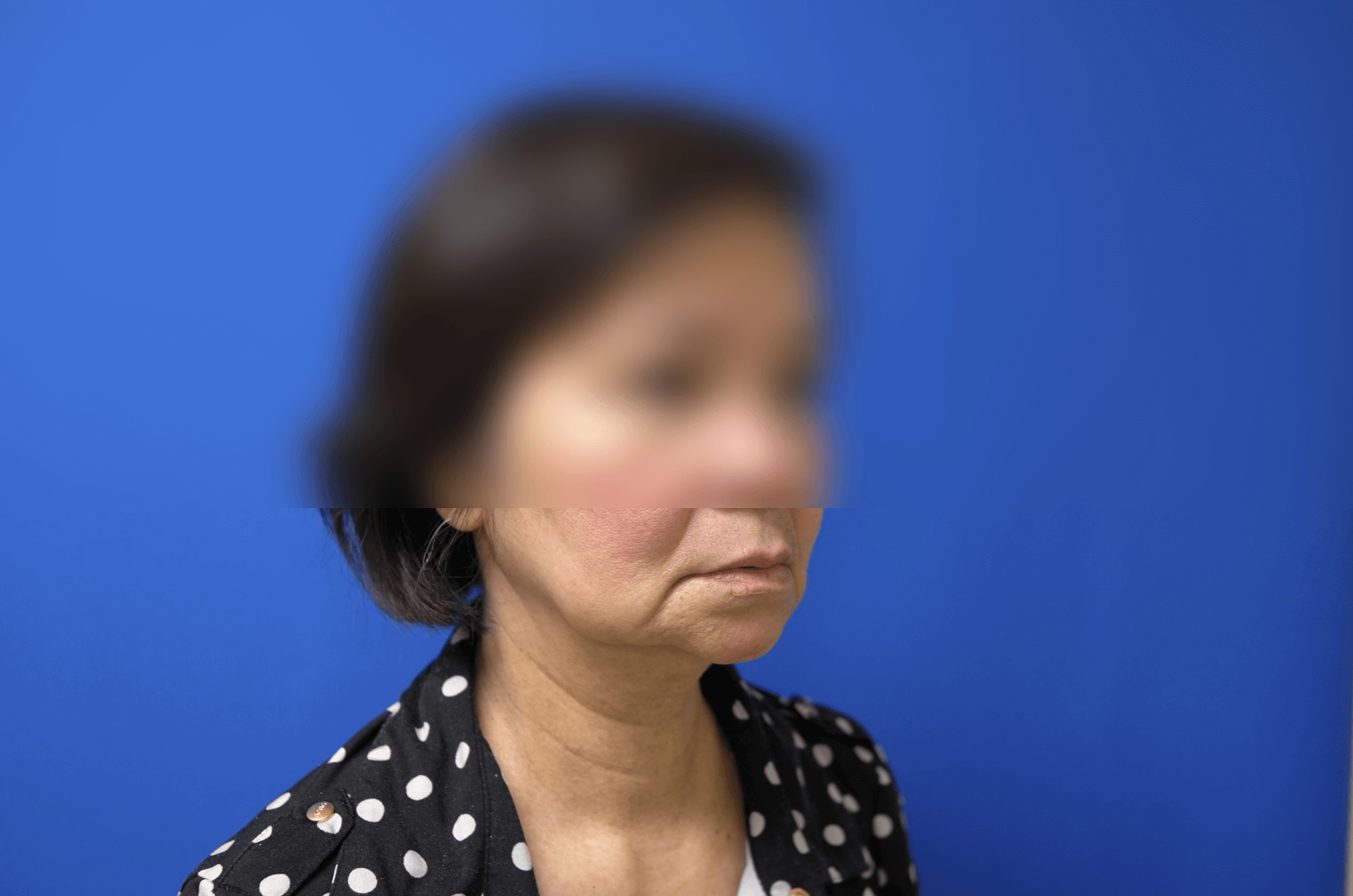 Facelift Before