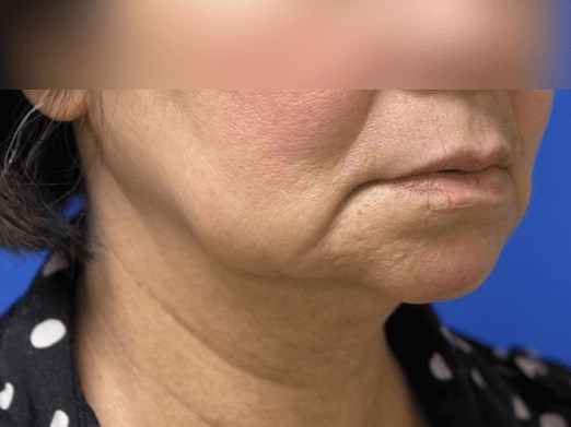 Facelift Before