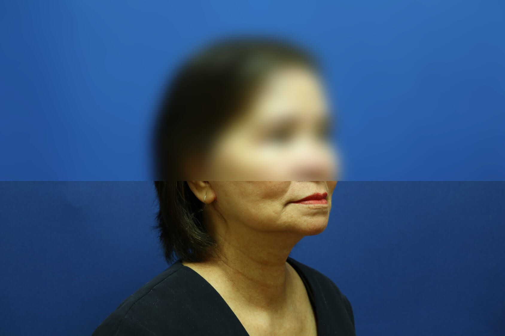 Facelift After