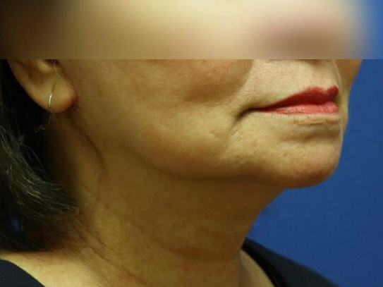 Facelift After