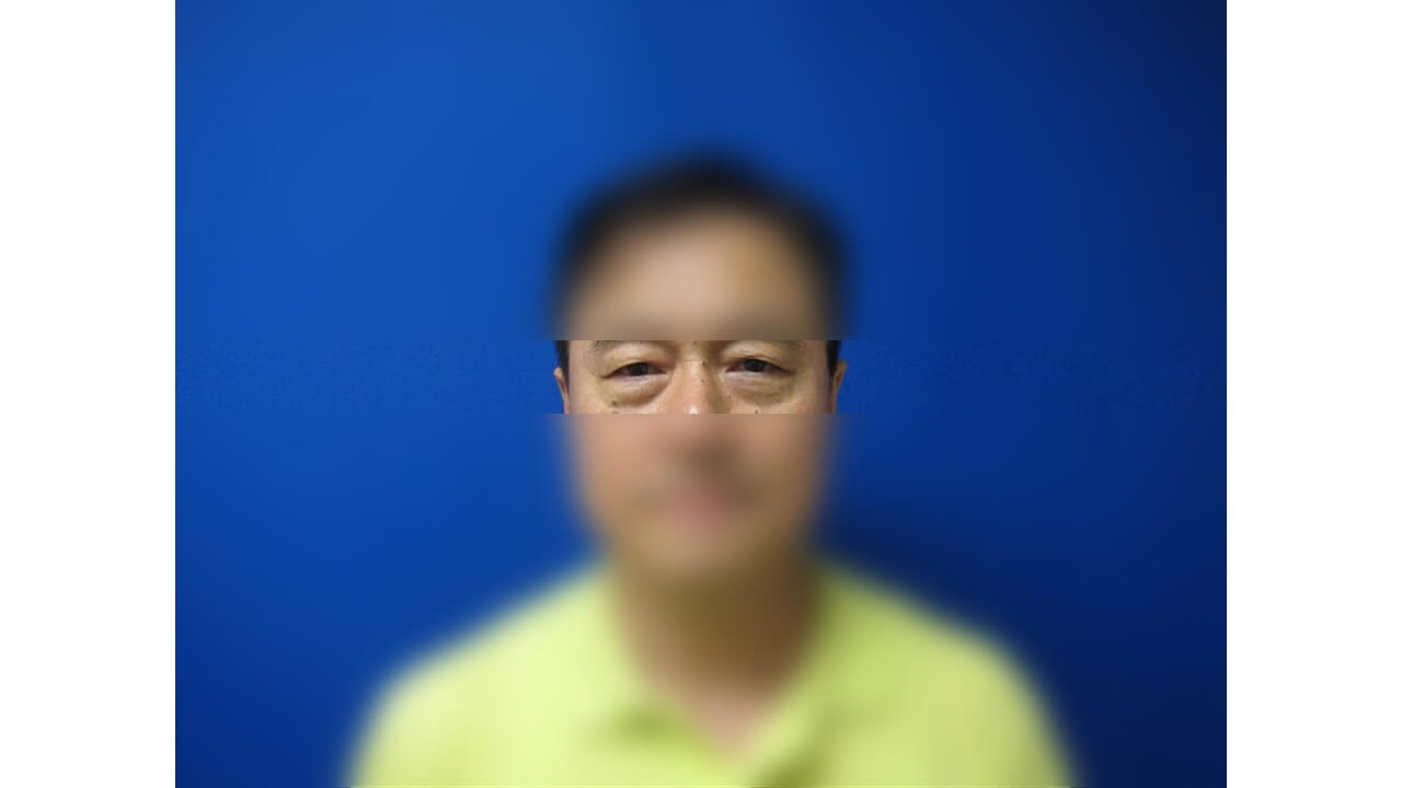 Lower Eyelid Surgery Before