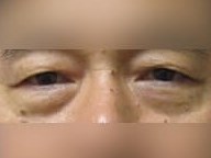 Lower Eyelid Surgery Before