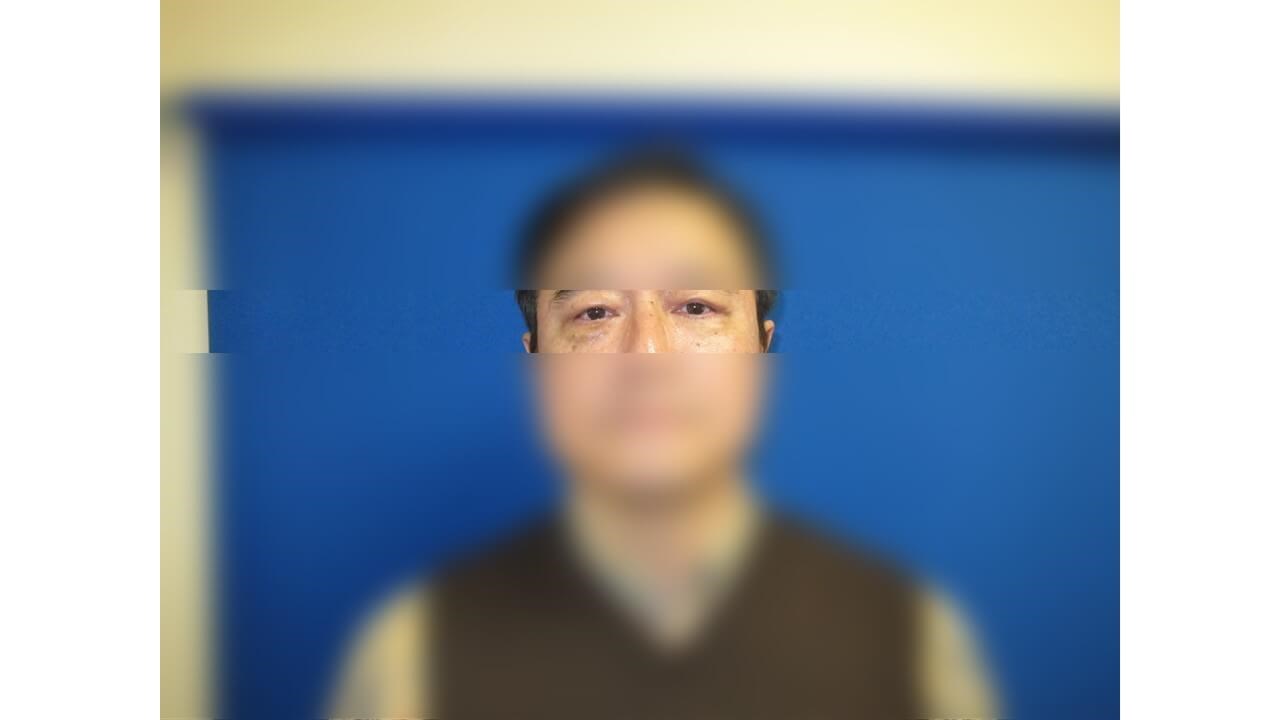 Lower Eyelid Surgery After