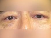 Lower Eyelid Surgery After