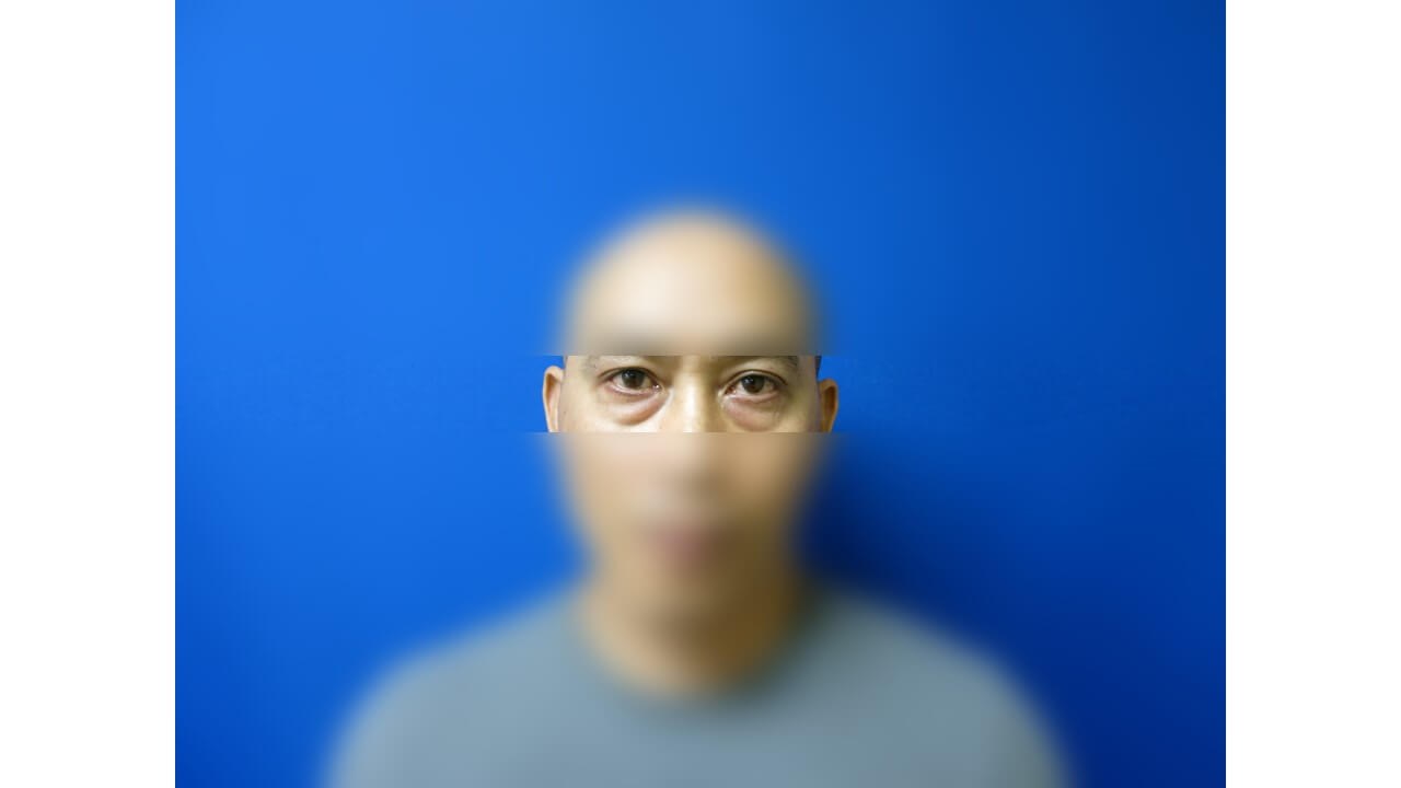 Lower Eyelid Surgery Before