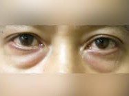 Lower Eyelid Surgery Before