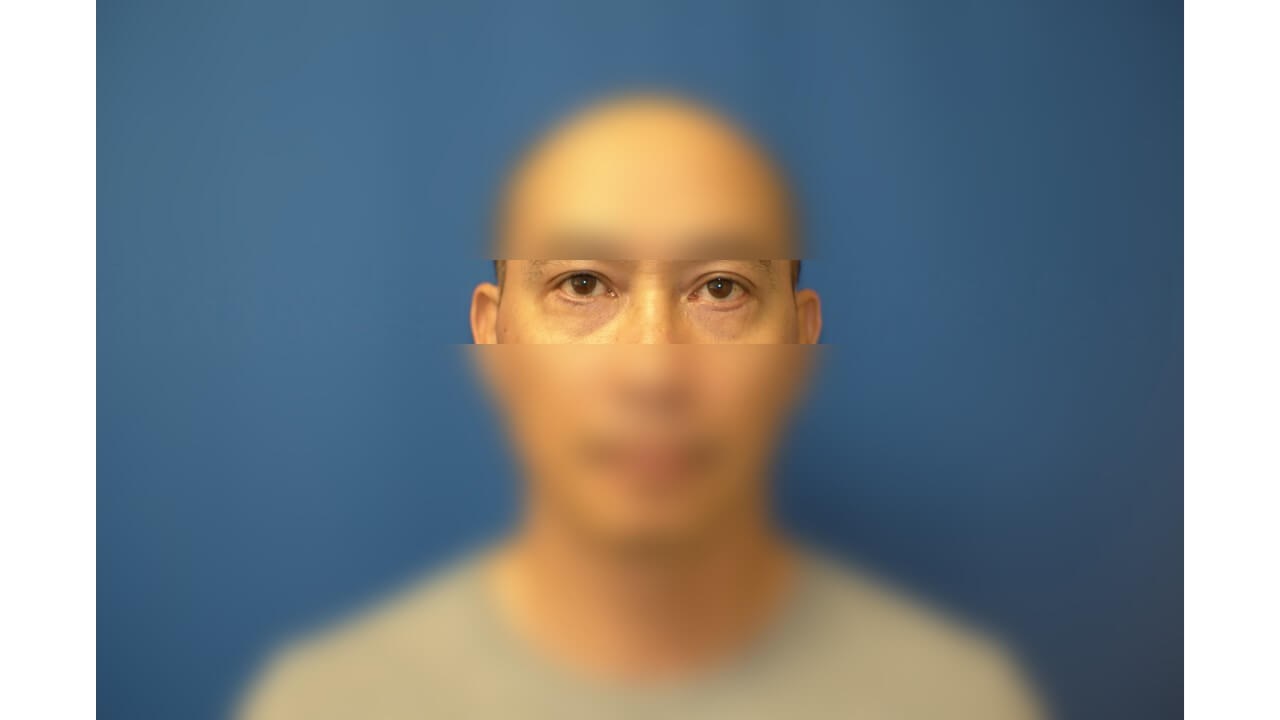 Lower Eyelid Surgery After