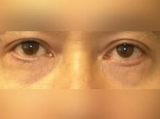Lower Eyelid Surgery After