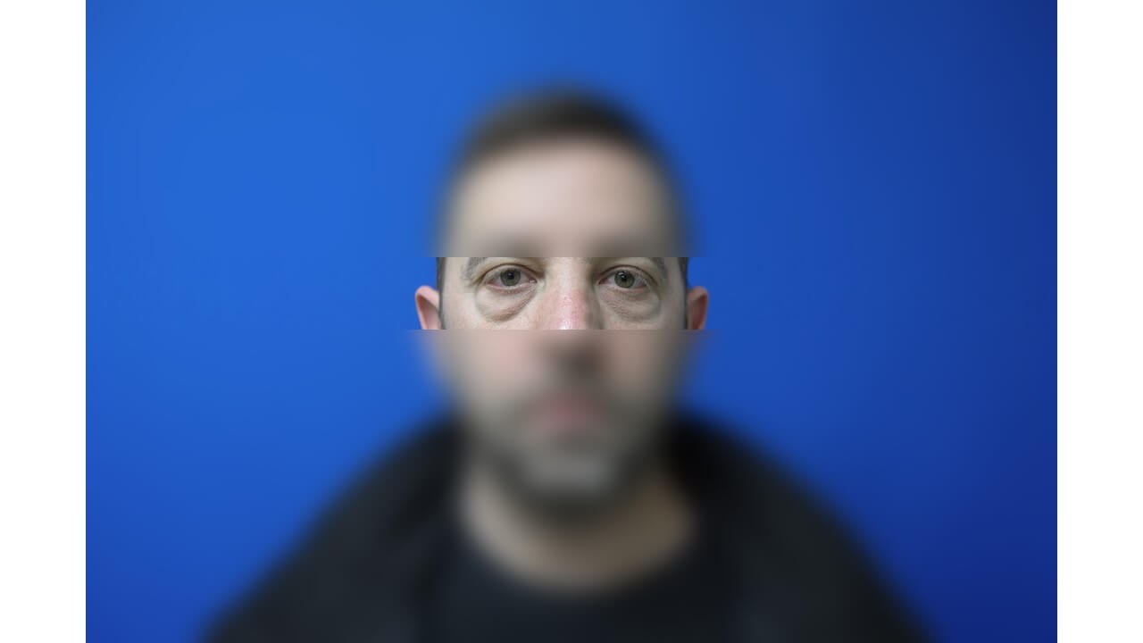 Lower Eyelid Surgery Before
