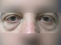 Lower Eyelid Surgery Before