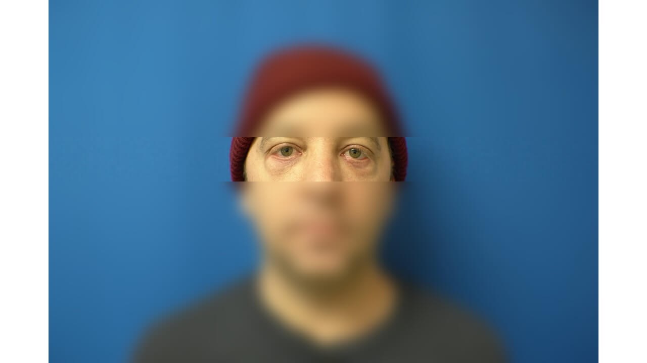 Lower Eyelid Surgery After