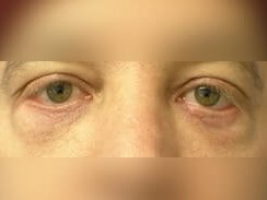 Lower Eyelid Surgery After