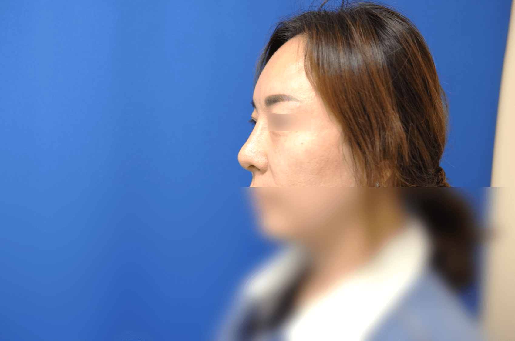 Rhinoplasty After