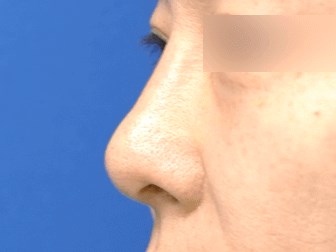 Rhinoplasty After