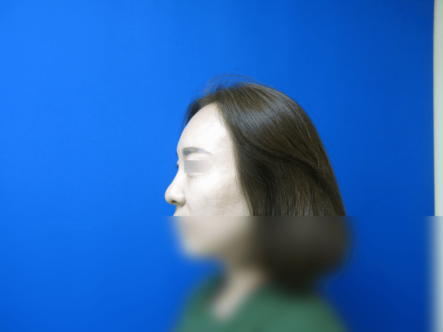 Rhinoplasty Before
