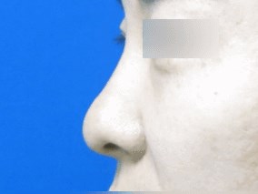 Rhinoplasty Before