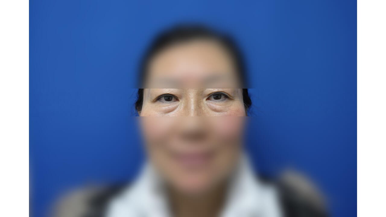 Lower Eyelid Surgery Before
