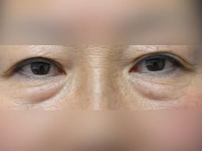 Lower Eyelid Surgery Before
