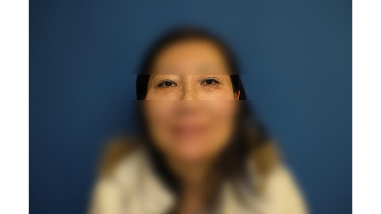 Lower Eyelid Surgery After