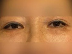 Lower Eyelid Surgery After
