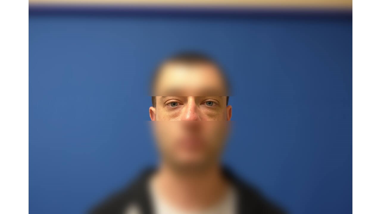 Lower Eyelid Surgery Before