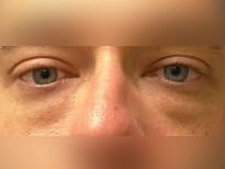 Lower Eyelid Surgery Before