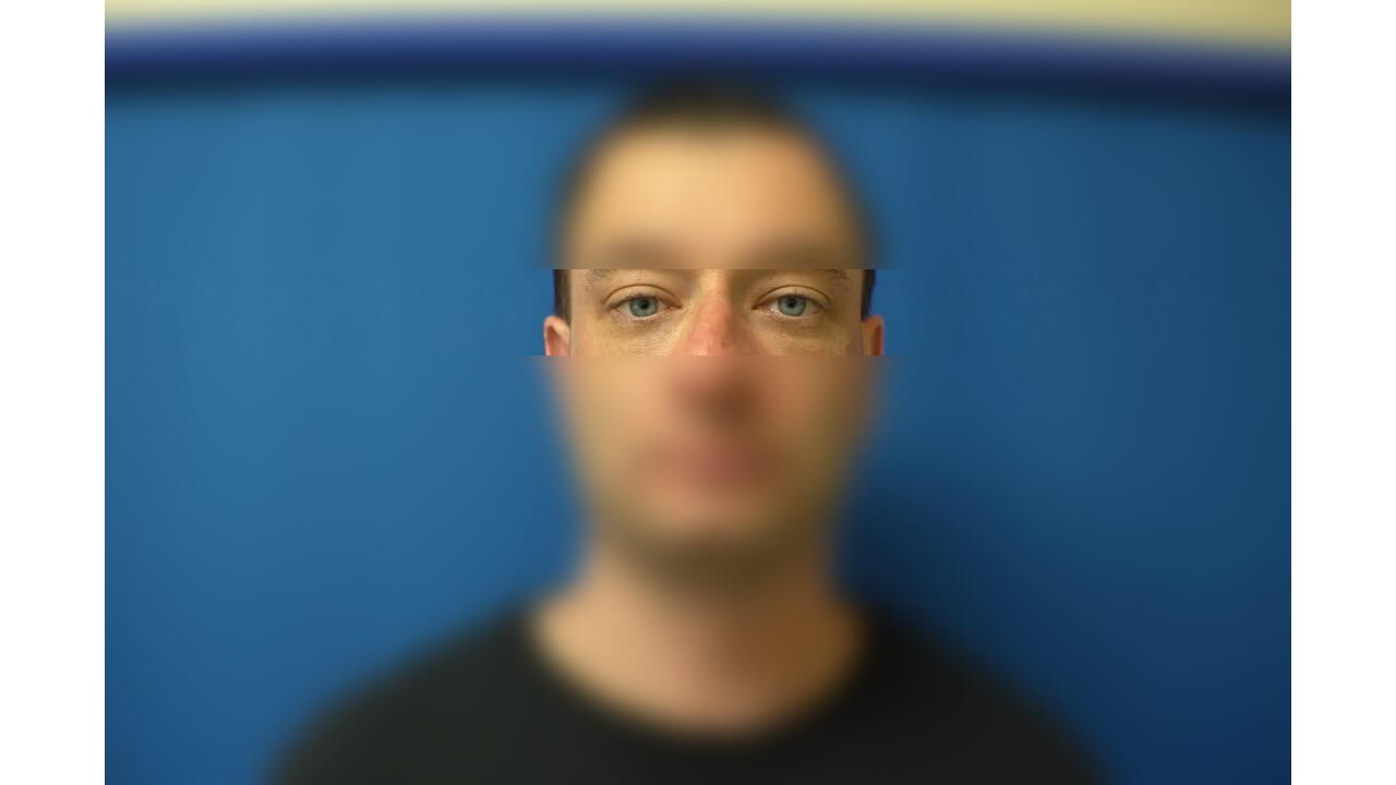 Lower Eyelid Surgery After
