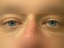 Lower Eyelid Surgery After