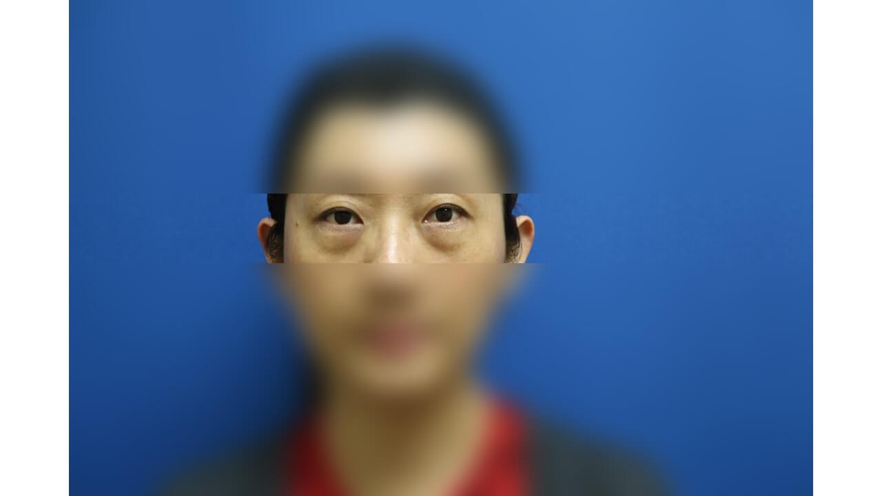 Lower Eyelid Surgery Before