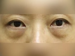 Lower Eyelid Surgery Before