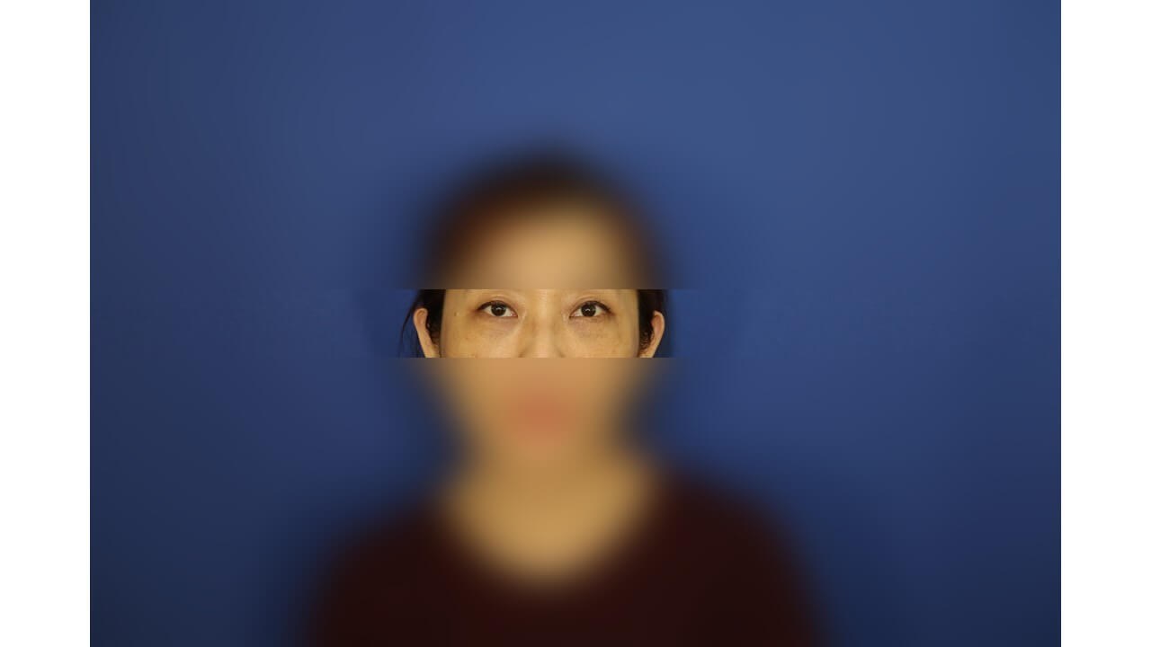 Lower Eyelid Surgery After