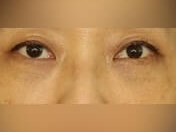 Lower Eyelid Surgery After