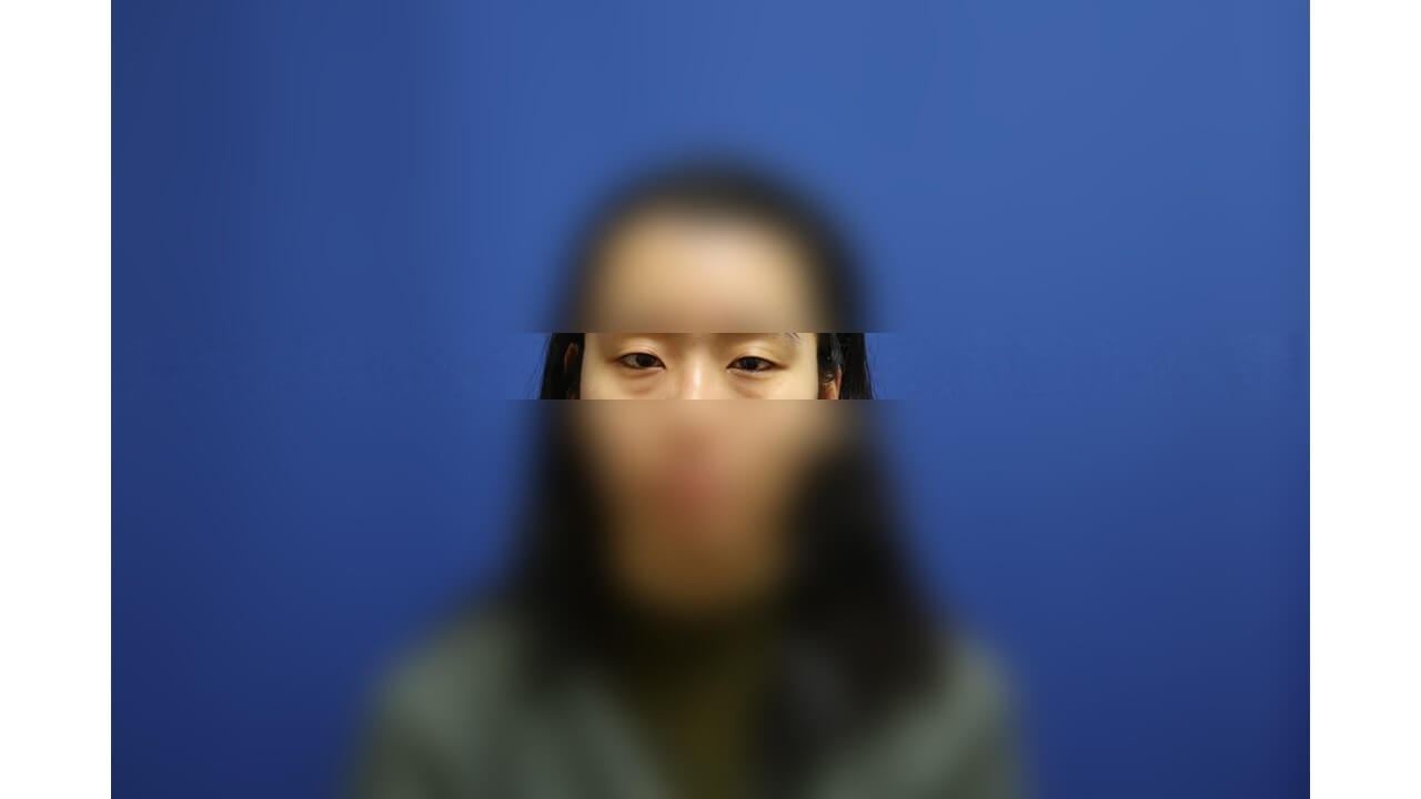 Lower Eyelid Surgery Before