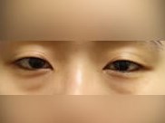 Lower Eyelid Surgery Before